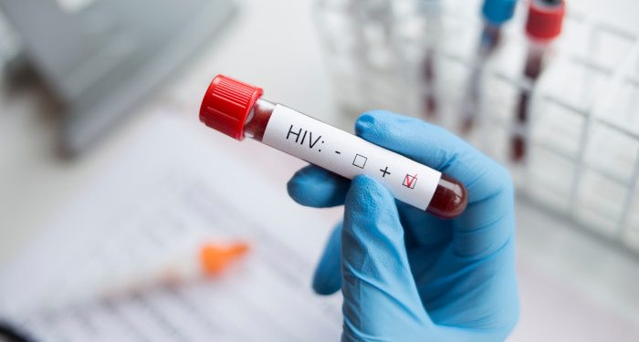 Boletim aponta alta detecção de HIV em São Luís e queda de casos de aids no Maranhão